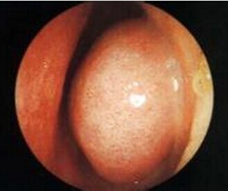 医生指出:肥厚性鼻炎与这些原因脱不了干系!