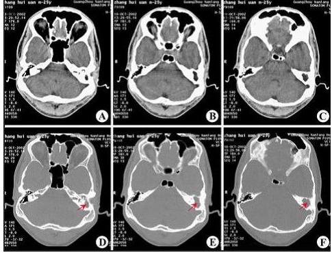 “乳突有效治疗术”祛除中耳炎乳突炎,遏制听力下降