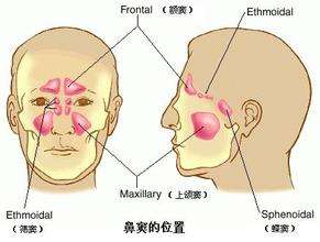 诱发鼻窦炎的三大主要原因
